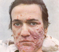Free! Acne Miracle Mix!